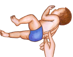 Spinal Galant Reflex