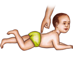 Spinal Perez Reflex